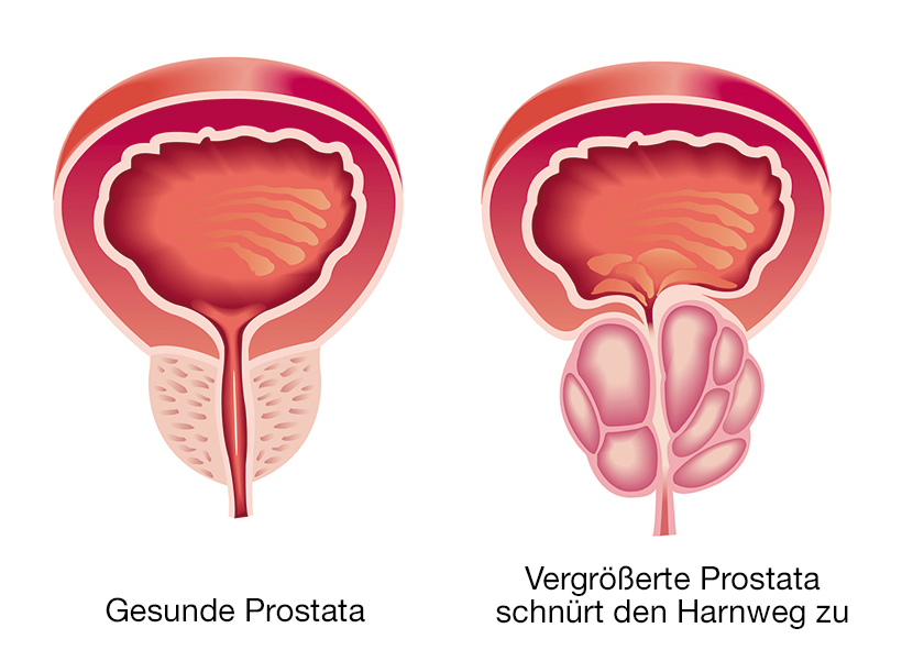 Der Alkohol hebend die Potenz